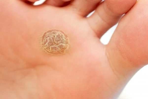 Callus Treatment